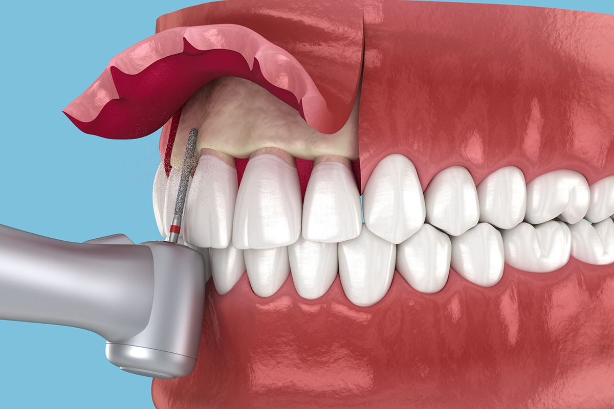 Enhancing your smile with crown lengthening in massapequa ny blog